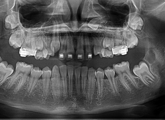 impacted teeth x-ray